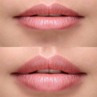 HYALURONIC ACID FILLER COURSE, GRADE II